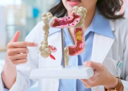 Câncer de intestino em jovens: estudo aponta as principais causas