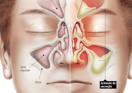 Saiba como tratar sinusite e evitar complicações como meningite