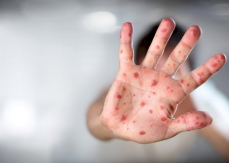 Entenda o que é a “dose zero' contra o sarampo, anunciada para bebês