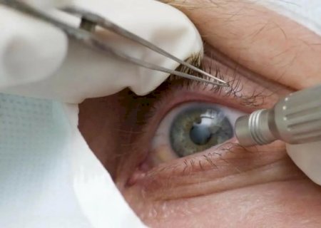 Cirurgia que altera cor do olho tem uso restrito para pessoas cegas