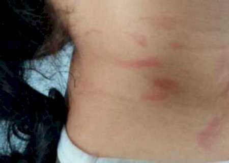 Espancada pelo marido, mulher teve duas costelas quebradas em MS