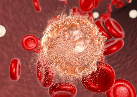 Leucemia mieloide aguda: estratégia muda paradigma do tratamento em idosos | Letra de Médico