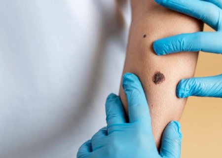 Carcinoma basocelular: o tipo mais comum de câncer de pele exige atenção