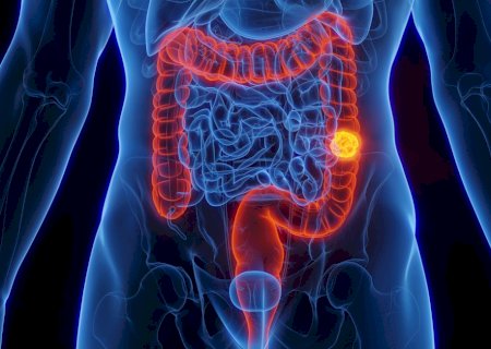 O efeito das canetas emagrecedoras no risco de câncer de intestino