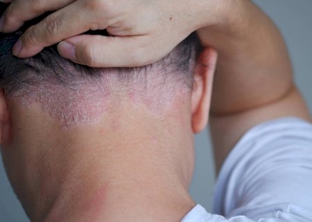 Entenda por que dermatite, caspa e psoríase pioram no inverno; médicos dão dicas de como cuidar