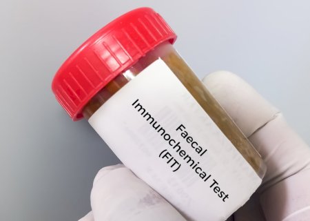 Novo teste com alta tecnologia para rastreamento do câncer de intestino chega ao SUS