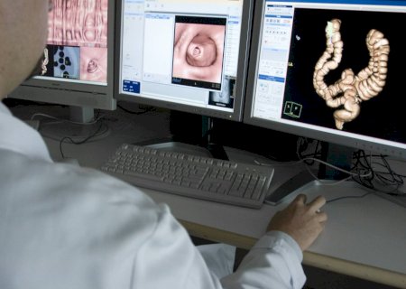 SUS incorpora teste mais eficaz para rastreamento de câncer colorretal