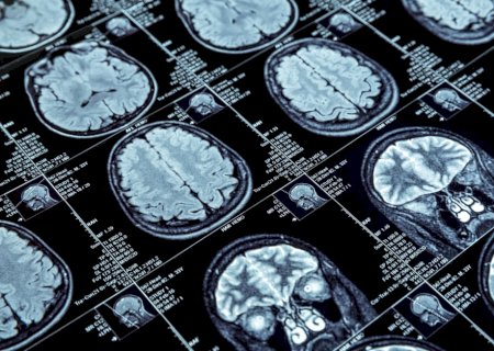 Consumo de açúcar na primeira infância aumenta risco de demência, diz estudo