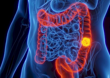 Estudo relaciona bactéria que afeta estômago a um em cada cinco casos de câncer colorretal