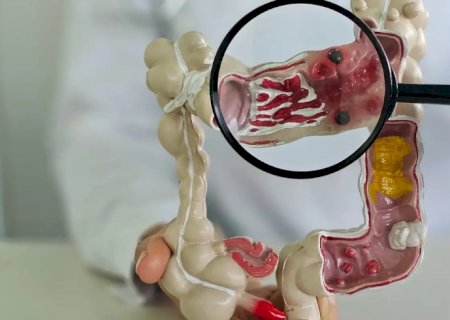 Em 13 anos, doença inflamatória intestinal cresce 5 vezes no Brasil