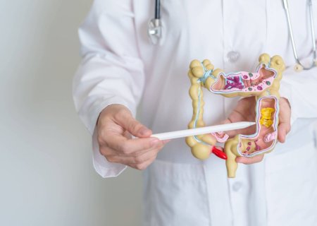 Estudo aponta possíveis causas da agressividade do câncer de intestino em jovens