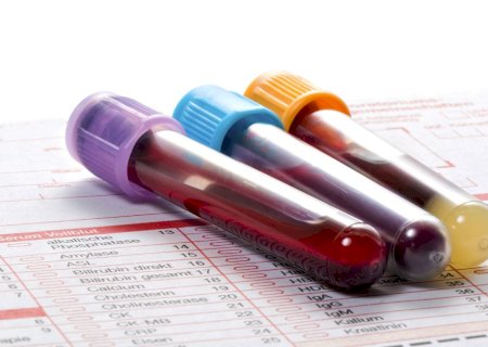 Novo exame de sangue para Alzheimer: quem deve fazer?